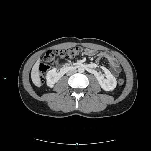 Adrenal cystic lymphangioma (Radiopaedia 83161-97534 Axial C+ portal venous phase 49).jpg