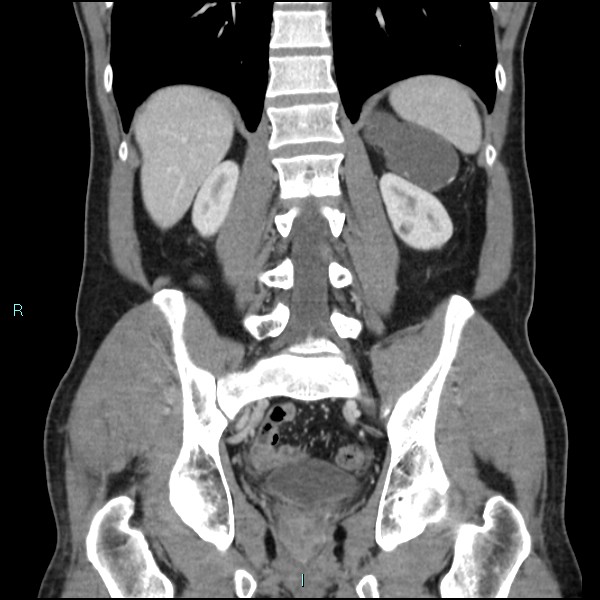 File:Adrenal cystic lymphangioma (Radiopaedia 83161-97534 Coronal C+ portal venous phase 52).jpg