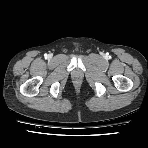 Adrenal gland trauma (Radiopaedia 81351-95078 Axial Dual bolus trauma C+ 124).jpg