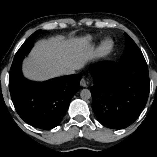 Adrenal gland trauma (Radiopaedia 81351-95079 Axial non-contrast 9).jpg