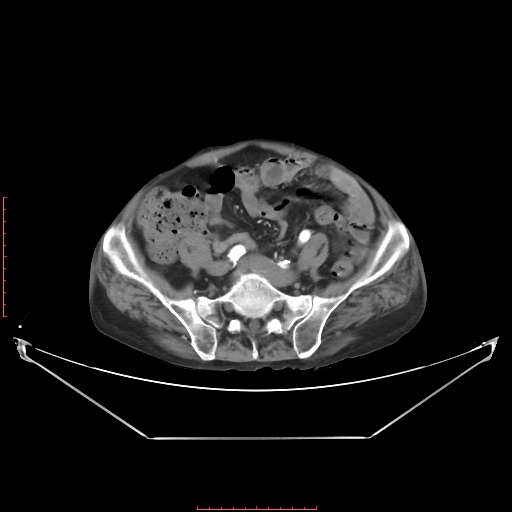 Adrenal hemangioma (Radiopaedia 68923-78668 Axial C+ arterial phase 54).jpg