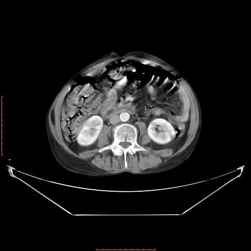 Adrenal hemangioma (Radiopaedia 68923-78668 Axial C+ portal venous phase 39).jpg