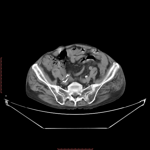 File:Adrenal hemangioma (Radiopaedia 68923-78668 Axial non-contrast 54).jpg