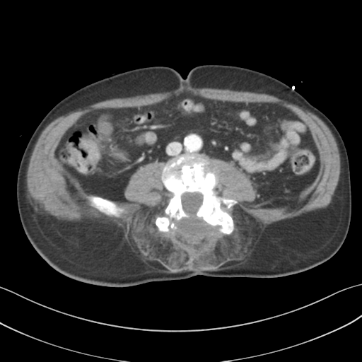 File:Adrenal hematoma (Radiopaedia 44334-47968 Axial C+ portal venous phase 47).png