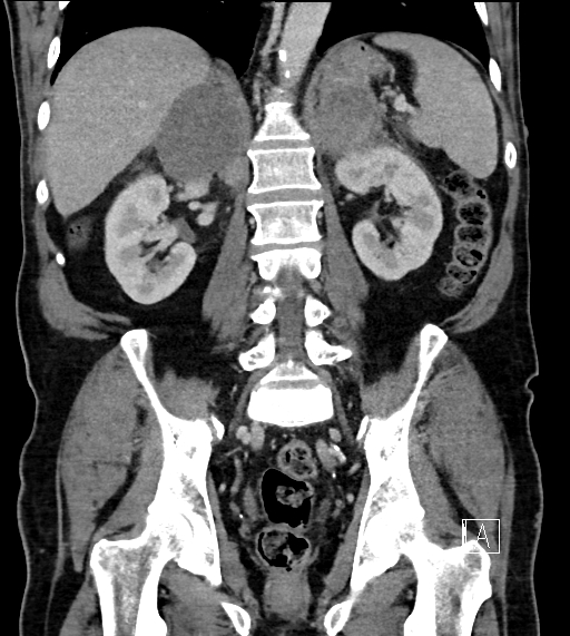 Adrenal lymphoma (Radiopaedia 73730-84529 Coronal C+ portal venous phase 53).jpg