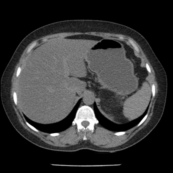 Adrenal myelolipoma (Radiopaedia 43401-46759 Axial non-contrast 19).jpg