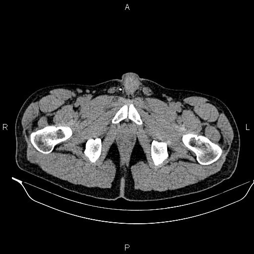File:Adrenal myelolipoma (Radiopaedia 87794-104246 Axial non-contrast 111).jpg