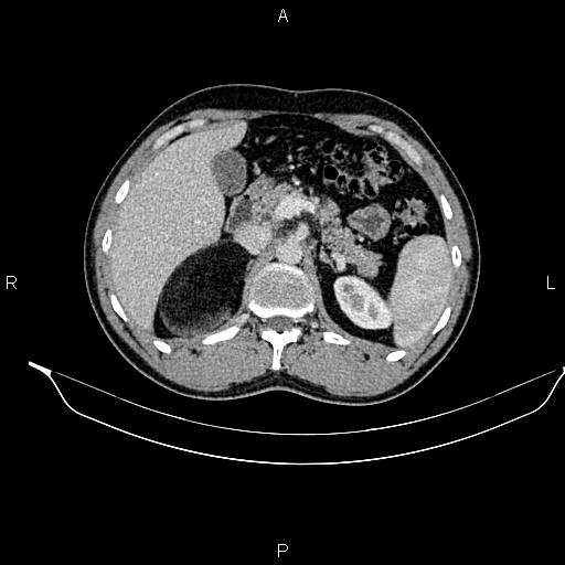 File:Adrenal myelolipoma (Radiopaedia 87794-104246 Axial renal cortical phase 34).jpg