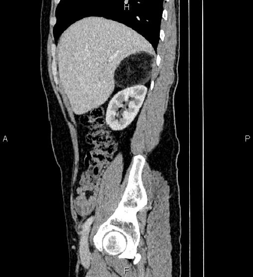 Adrenal myelolipoma (Radiopaedia 87794-104246 Sagittal renal cortical phase 24).jpg
