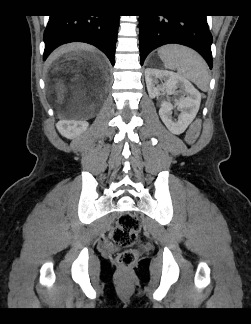 Adrenal myelolipoma - bilateral (Radiopaedia 74805-85810 Coronal C+ portal venous phase 103).jpg