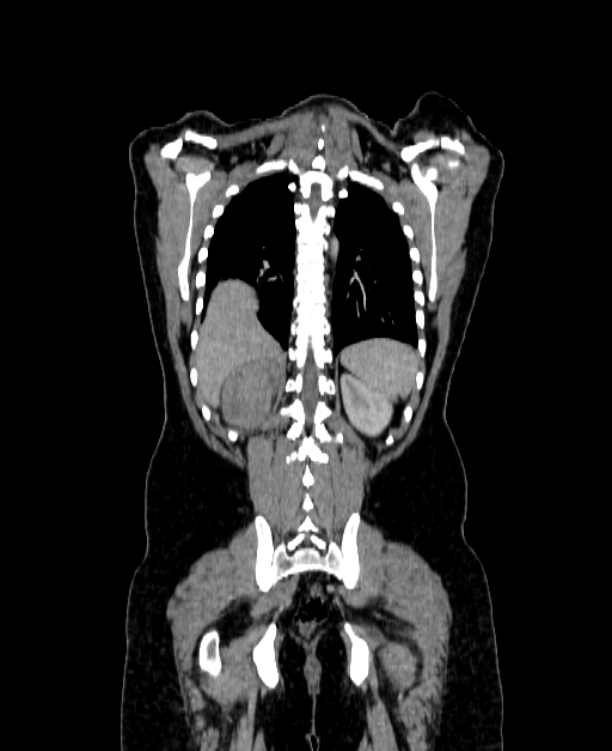 Adrenocortical carcinoma (Radiopaedia 80134-93438 Coronal C+ portal venous phase 129).jpg