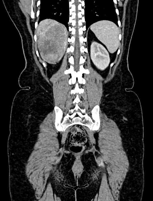 Adrenocortical carcinoma (Radiopaedia 87281-103569 Coronal C+ portal venous phase 115).jpg