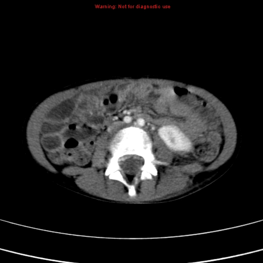 File:Adrenocortical carcinoma (Radiopaedia 9449-10131 Axial C+ portal venous phase 34).jpg