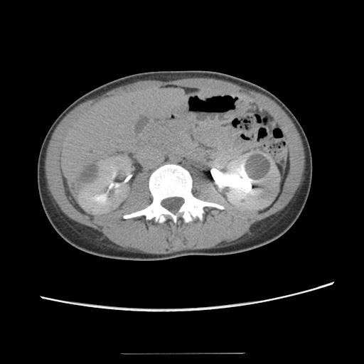 File:Adult polycystic kidney disease (Radiopaedia 48845-53876 Axial renal excretory phase 43).jpg