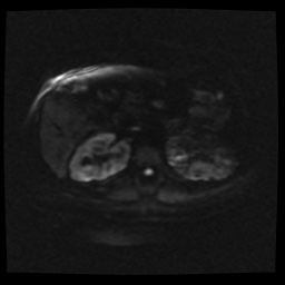 Adult polycystic kidney disease (Radiopaedia 59075-66365 Axial DWI 53).jpg