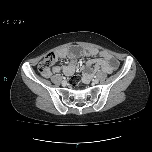 File:Adult transient intestinal intussusception (Radiopaedia 34853-36310 Axial C+ portal venous phase 76).jpg