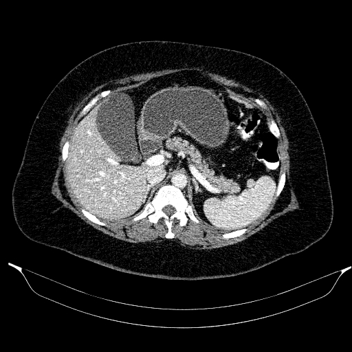 Afferent loop syndrome - secondary to incarcerated trocar site hernia (Radiopaedia 82959-97305 Axial C+ portal venous phase 68).jpg