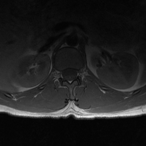 File:Aggressive vertebral hemangioma (Radiopaedia 39937-42404 Axial T1 2).png