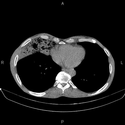 Air bronchogram in pneumonia (Radiopaedia 85719-101512 Axial non-contrast 48).jpg