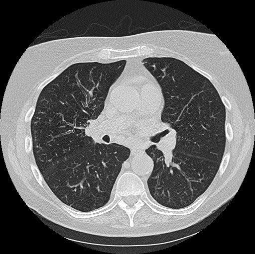 Alpha-1-antitrypsin deficiency (Radiopaedia 72058-82557 Axial lung window 35).jpg
