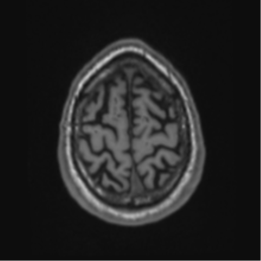 Alzheimer's disease- with Gerstmann syndrome and dressing apraxia (Radiopaedia 54882-61150 Axial T1 66).png