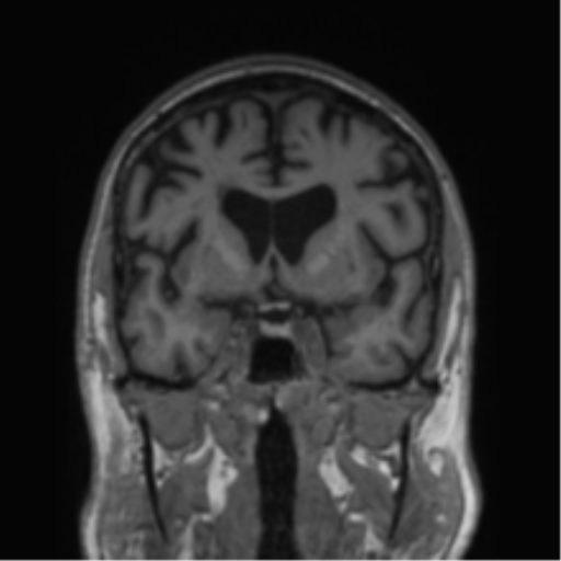 Alzheimer's disease- with Gerstmann syndrome and dressing apraxia (Radiopaedia 54882-61150 Coronal T1 56).png