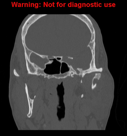 File:Ameloblastoma (Radiopaedia 13276-13280 Coronal non-contrast 18).jpg