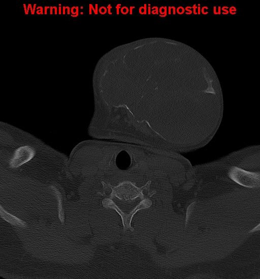 File:Ameloblastoma (Radiopaedia 33126-34164 Axial bone window 33).jpg