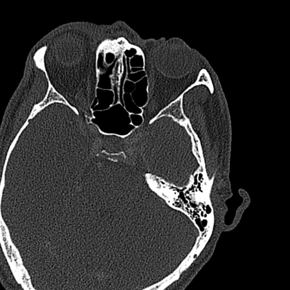 Ameloblastoma (Radiopaedia 51921-57766 Axial bone window 174).jpg