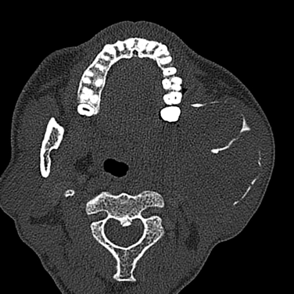Ameloblastoma (Radiopaedia 51921-57766 Axial bone window 92).jpg