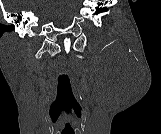 Ameloblastoma (Radiopaedia 51921-57766 Coronal bone window 206).jpg