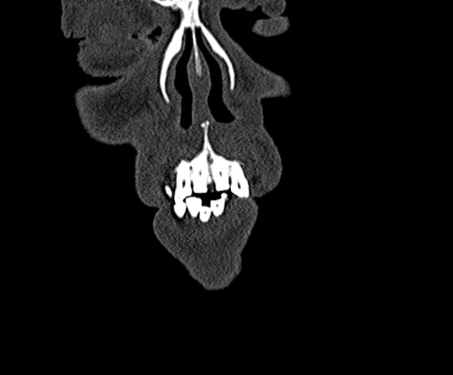 Ameloblastoma (Radiopaedia 51921-57766 Coronal bone window 9).jpg