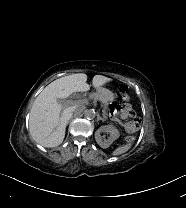 Amiodarone deposition in the liver (Radiopaedia 77587-89780 Axial non-contrast 87).jpg