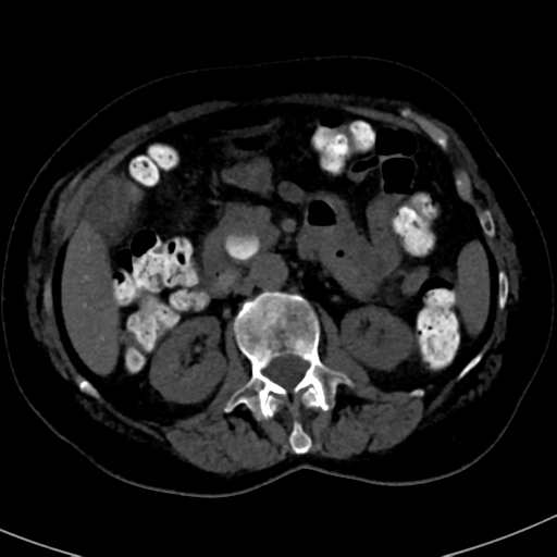 File:Ampullary adenocarcinoma (Radiopaedia 34013-35241 AXIAL THICK 39).png