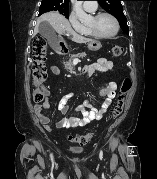 Ampullary adenocarcinoma (Radiopaedia 59373-66734 D 34).jpg