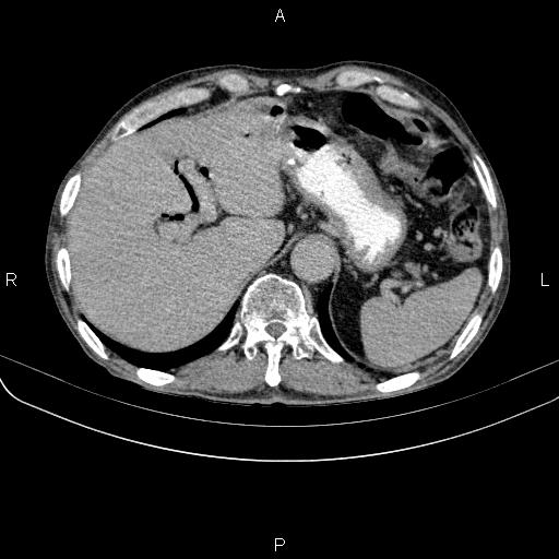 Ampullary adenocarcinoma (Radiopaedia 86093-102033 Axial C+ delayed 23).jpg