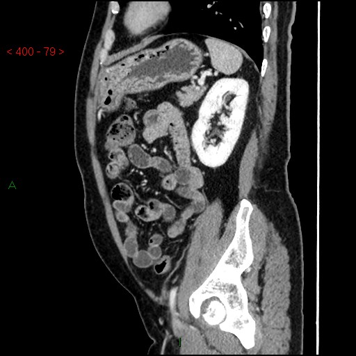 Ampullary carcinoma (Radiopaedia 56396-63056 D 78).jpg