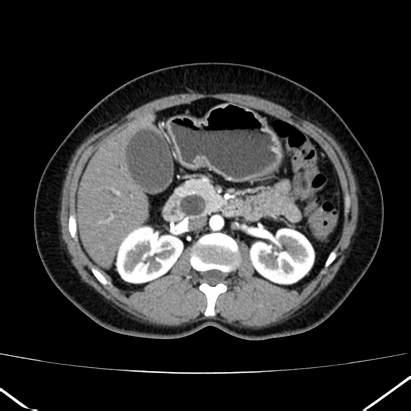 Ampullary tumor (Radiopaedia 22787-22816 B 36).jpg