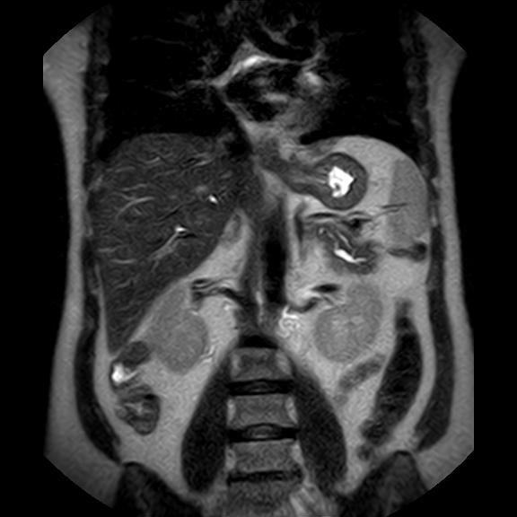 File:Ampullary tumor (Radiopaedia 27294-27479 Coronal T2 15).jpg