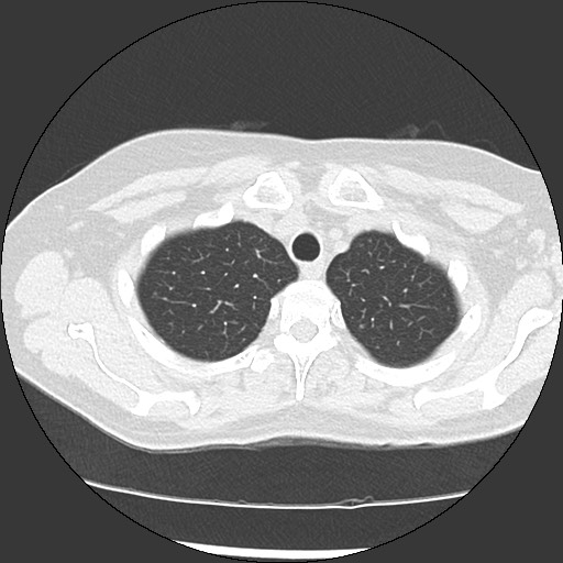 Amyloidosis - bronchial and diffuse nodular pulmonary involvement (Radiopaedia 60156-67744 B 10).jpg