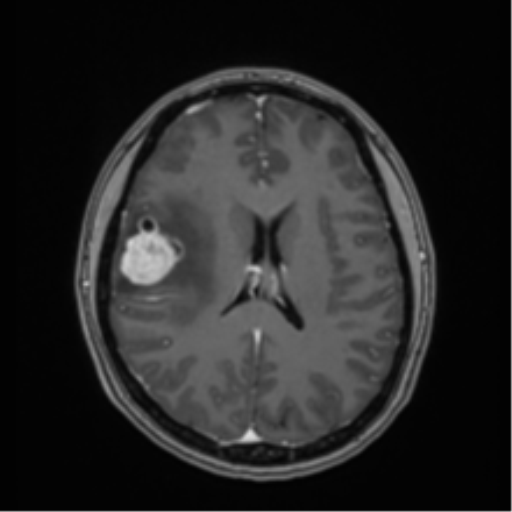 Anaplastic astroblastoma (Radiopaedia 55666-62194 Axial T1 C+ 46).png