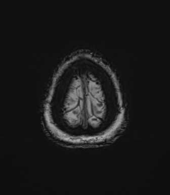 File:Anaplastic astrocytoma (Radiopaedia 86943-103160 Axial SWI 85).png