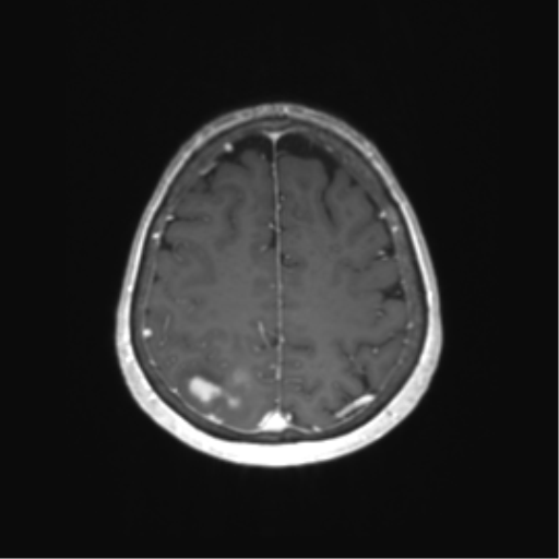 File:Anaplastic astrocytoma (Radiopaedia 86943-103160 Axial T1 C+ 65).png
