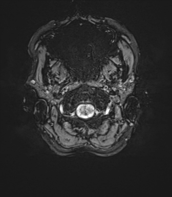File:Anaplastic astrocytoma IDH mutant (Radiopaedia 50046-55341 Axial SWI 3).png
