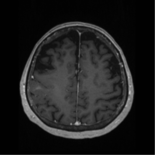 File:Anaplastic astrocytoma IDH wild-type (pseudoprogression) (Radiopaedia 42209-45276 Axial T1 C+ 108).png