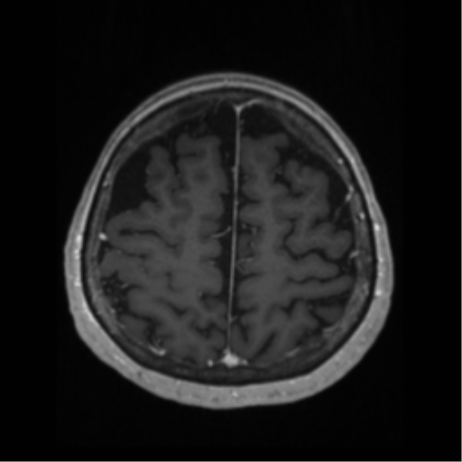 File:Anaplastic astrocytoma IDH wild-type (pseudoprogression) (Radiopaedia 42209-45276 Axial T1 C+ 114).png