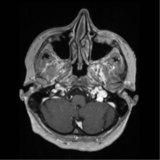 File:Anaplastic astrocytoma IDH wild-type (pseudoprogression) (Radiopaedia 42209-45276 Axial T1 C+ 30).png