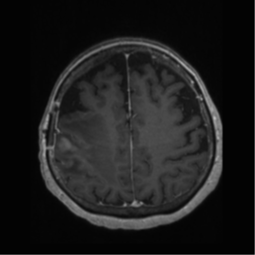 File:Anaplastic astrocytoma IDH wild-type (pseudoprogression) (Radiopaedia 42209-45277 Axial T1 C+ 92).png