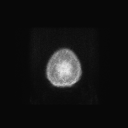 Anaplastic astrocytoma IDH wild-type (pseudoprogression) (Radiopaedia 42209-45279 Axial T1 C+ 147).png