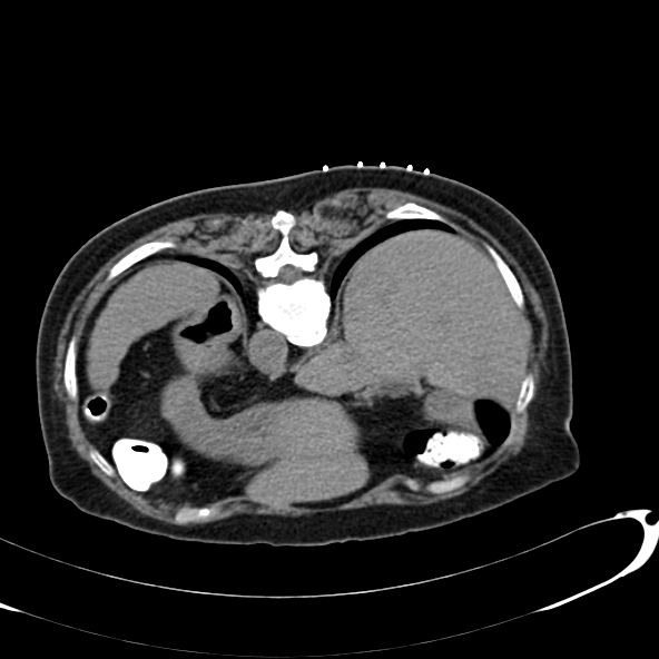 File:Anaplastic lymphoma - with CT biopsy (Radiopaedia 21643-21602 Axial non-contrast 1).jpg